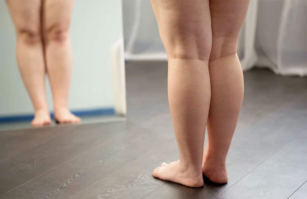 Lipoaspiração para Lipedema pelo Plano de Saúde: Como Garantir a Cobertura